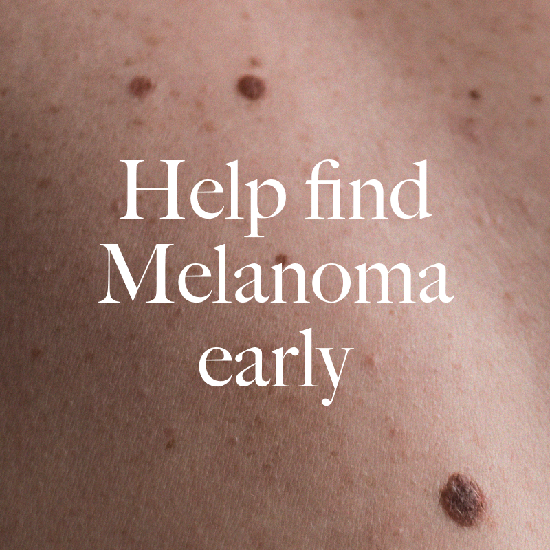 Practice Skintimacy: Help find Melanoma early